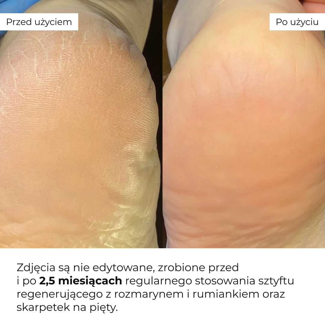 Set pentru călcâie crăpate cu rozmarin și mușețel — Hillary HydraHeel Repair & Comfort Set